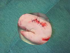 suture sur pied de cochon